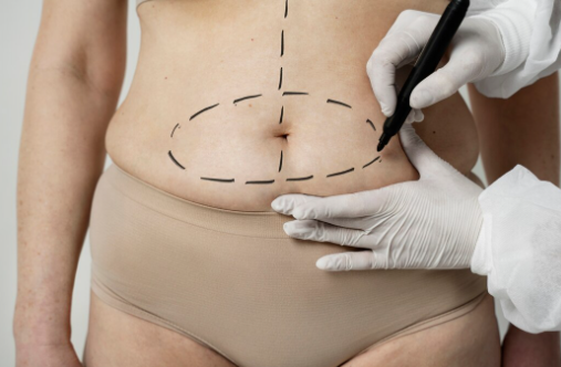 Abdominoplasty-Recovery